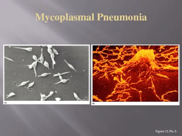 Mycoplasmal Pneumonia Figure 11.19a, b