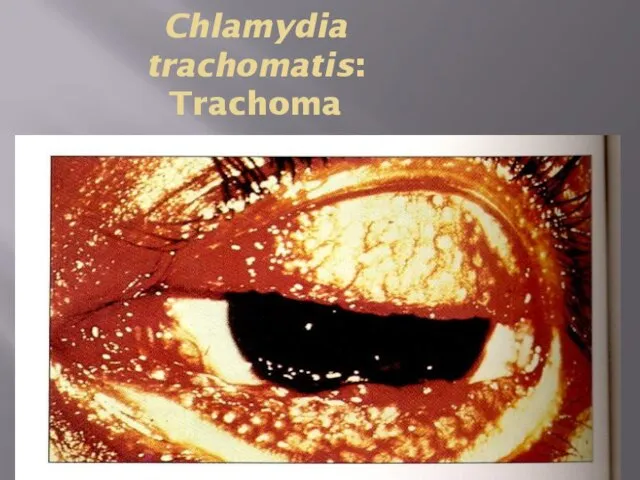 Chlamydia trachomatis: Trachoma