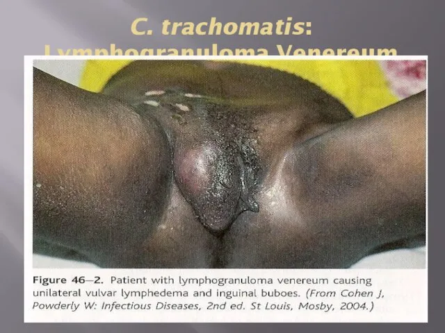 C. trachomatis: Lymphogranuloma Venereum