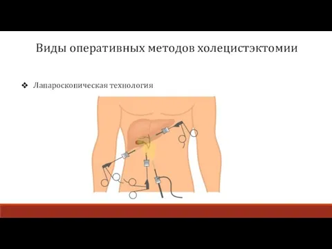 Виды оперативных методов холецистэктомии Лапароскопическая технология