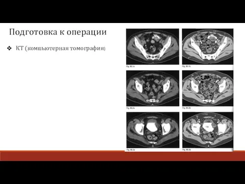 КТ (компьютерная томография) Подготовка к операции