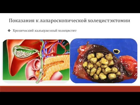 Показания к лапароскопической холецистэктомии Хронический калькулезный холецистит