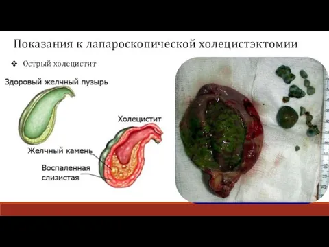 Острый холецистит Показания к лапароскопической холецистэктомии