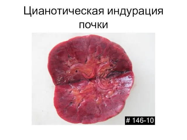 Цианотическая индурация почки