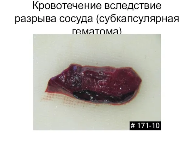 Кровотечение вследствие разрыва сосуда (субкапсулярная гематома)