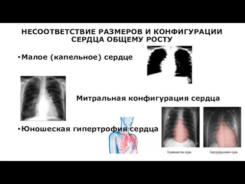 НЕСООТВЕТСТВИЕ РАЗМЕРОВ И КОНФИГУРАЦИИ СЕРДЦА ОБЩЕМУ РОСТУ Малое (капельное) сердце Митральная конфигурация сердца Юношеская гипертрофия сердца