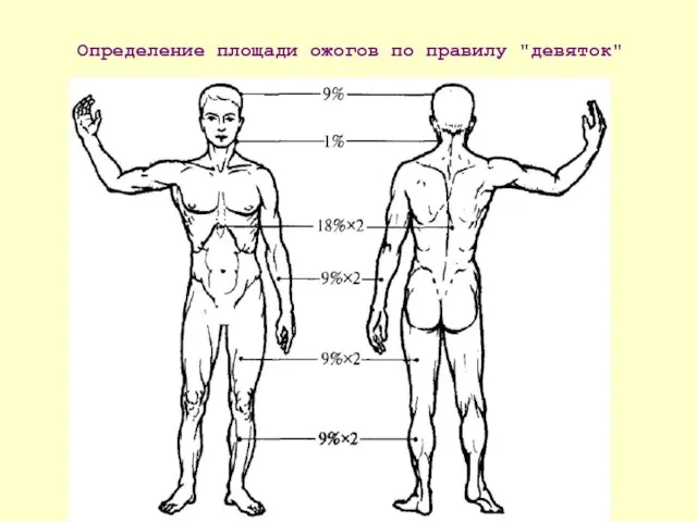 Определение площади ожогов по правилу "девяток"