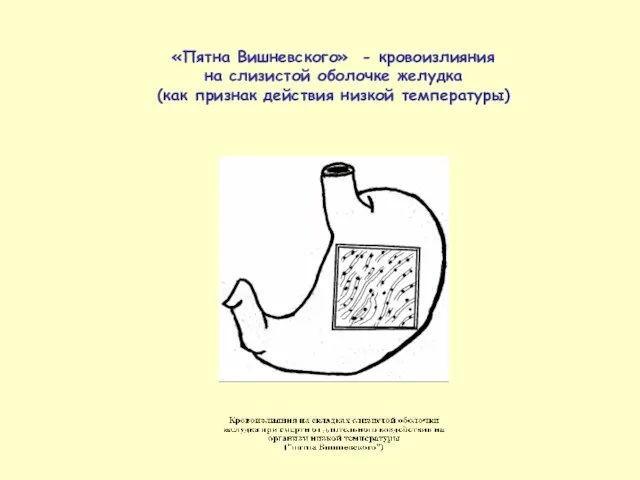 «Пятна Вишневского» - кровоизлияния на слизистой оболочке желудка (как признак действия низкой температуры)