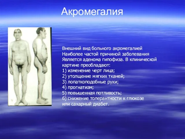 Акромегалия Внешний вид больного акромегалией Наиболее частой причиной заболевания Является аденома