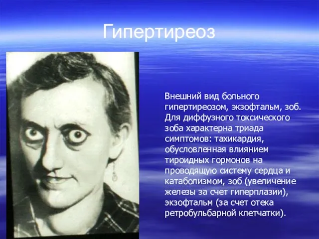 Гипертиреоз Внешний вид больного гипертиреозом, экзофтальм, зоб. Для диффузного токсического зоба