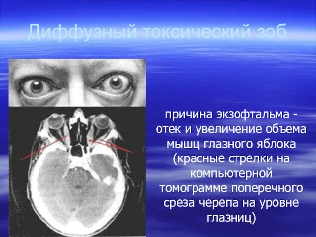 Диффузный токсический зоб причина экзофтальма - отек и увеличение объема мышц