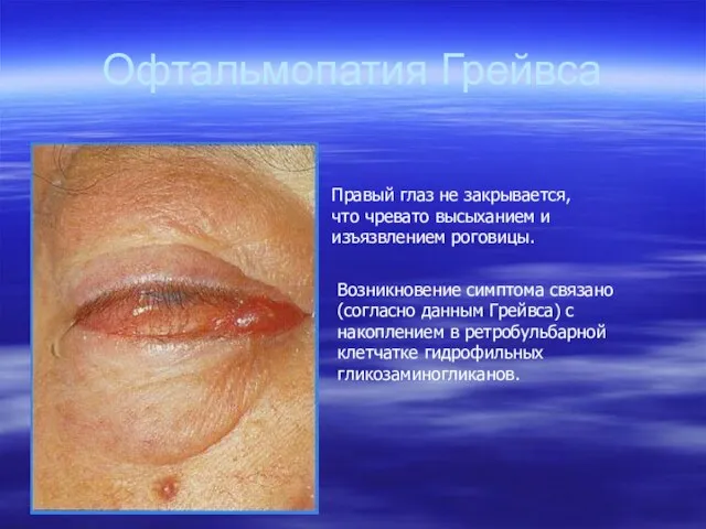 Офтальмопатия Грейвса Правый глаз не закрывается, что чревато высыханием и изъязвлением