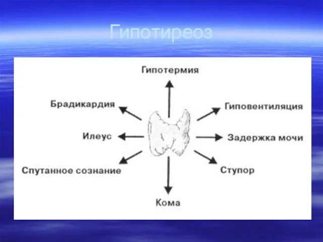 Гипотиреоз