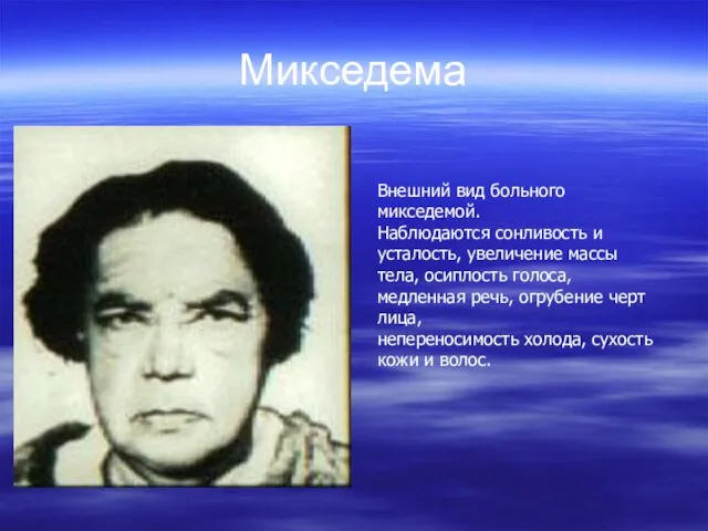 Микседема Внешний вид больного микседемой. Наблюдаются сонливость и усталость, увеличение массы