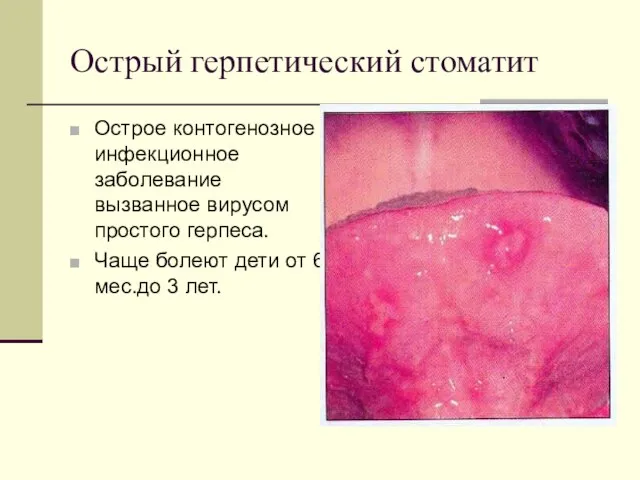 Острый герпетический стоматит Острое контогенозное инфекционное заболевание вызванное вирусом простого герпеса.