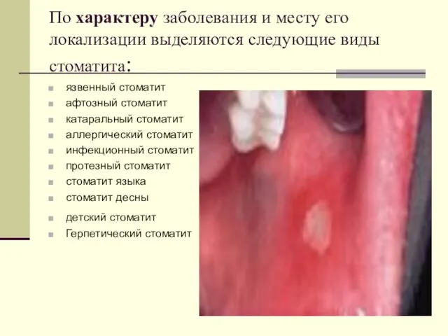 По характеру заболевания и месту его локализации выделяются следующие виды стоматита: