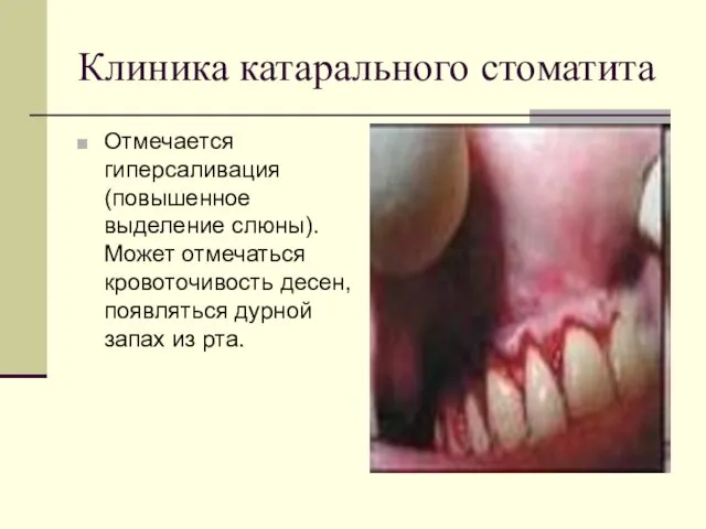 Клиника катарального стоматита Отмечается гиперсаливация (повышенное выделение слюны). Может отмечаться кровоточивость