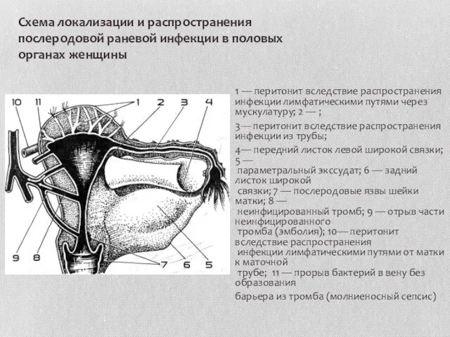 Схема локализации и распространения послеродовой раневой инфекции в половых органах женщины