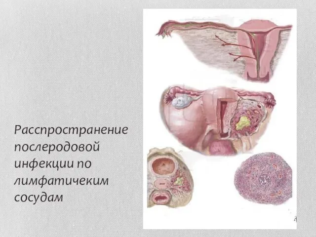 Расспространение послеродовой инфекции по лимфатичеким сосудам