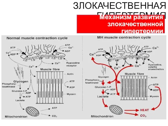 ЗЛОКАЧЕСТВЕННАЯ ГИПЕРТЕРМИЯ Механизм развития злокачественной гипертермии