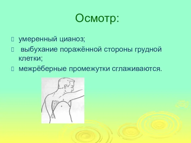 Осмотр: умеренный цианоз; выбухание поражённой стороны грудной клетки; межрёберные промежутки сглаживаются.