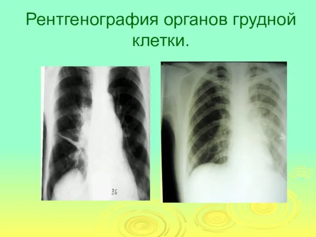 Рентгенография органов грудной клетки.