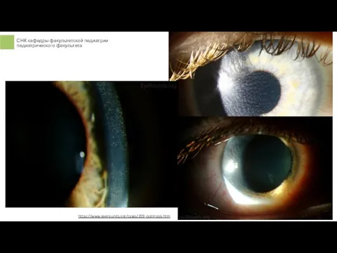 https://www.eyerounds.org/cases/209-cystinosis.htm