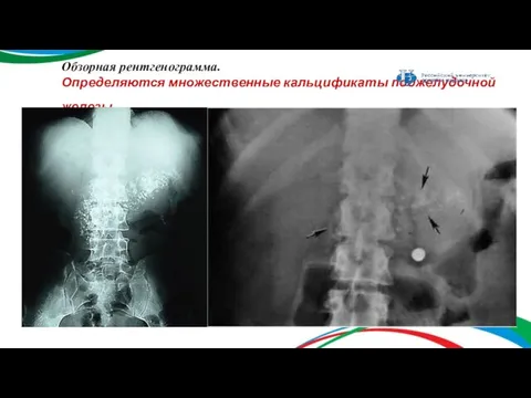 Обзорная рентгенограмма. Определяются множественные кальцификаты поджелудочной железы