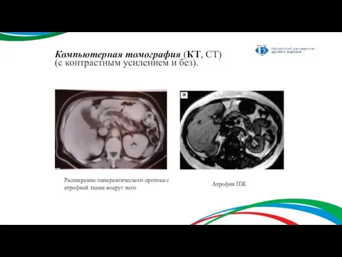 Компьютерная томография (КТ, СТ) (с контрастным усилением и без). Расширение панкреатического