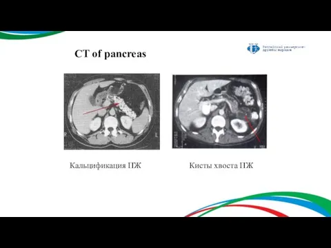 CT of pancreas Кальцификация ПЖ Кисты хвоста ПЖ