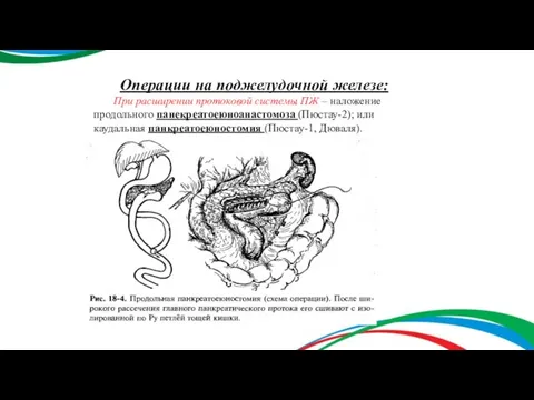 Операции на поджелудочной железе: При расширении протоковой системы ПЖ – наложение