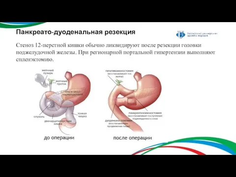 Панкреато-дуоденальная резекция Стеноз 12-перстной кишки обычно ликвидируют после резекции головки поджелудочной