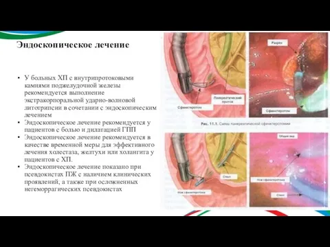 Эндоскопическое лечение У больных ХП с внутрипротоковыми камнями поджелудочной железы рекомендуется