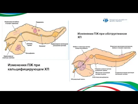 Изменения ПЖ при кальцифицирующем ХП Изменения ПЖ при обструктивном ХП