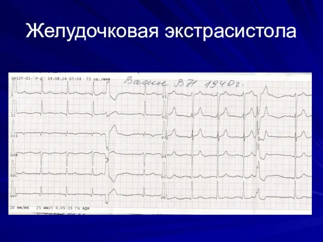 Желудочковая экстрасистола