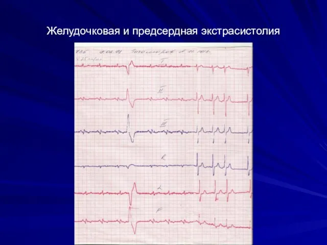 Желудочковая и предсердная экстрасистолия