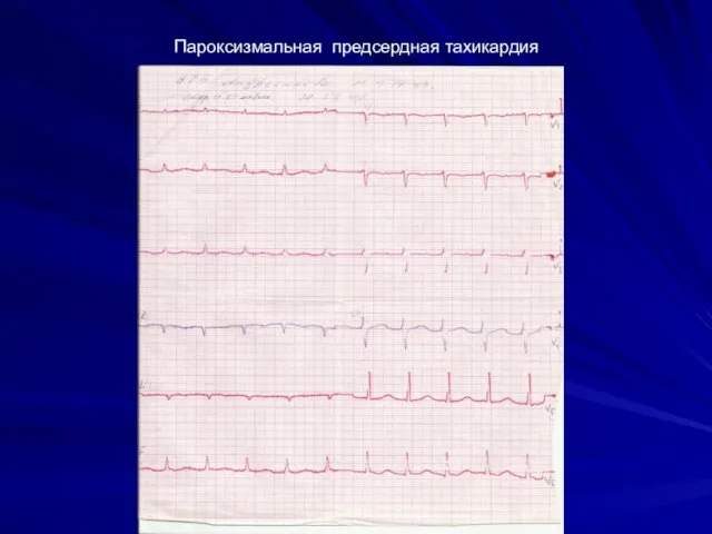 Пароксизмальная предсердная тахикардия