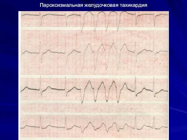 Пароксизмальная желудочковая тахикардия