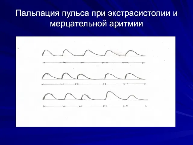 Пальпация пульса при экстрасистолии и мерцательной аритмии