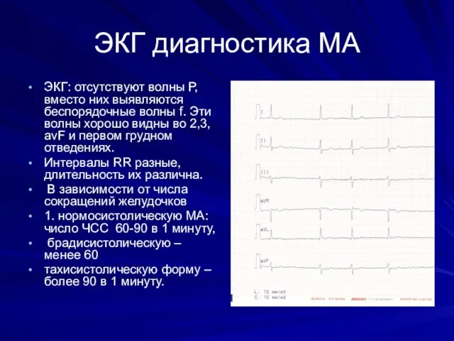 ЭКГ диагностика МА ЭКГ: отсутствуют волны Р, вместо них выявляются беспорядочные