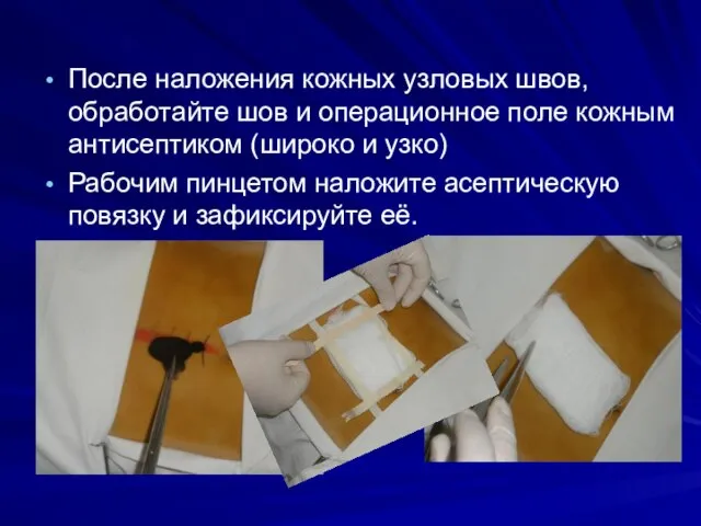 После наложения кожных узловых швов, обработайте шов и операционное поле кожным