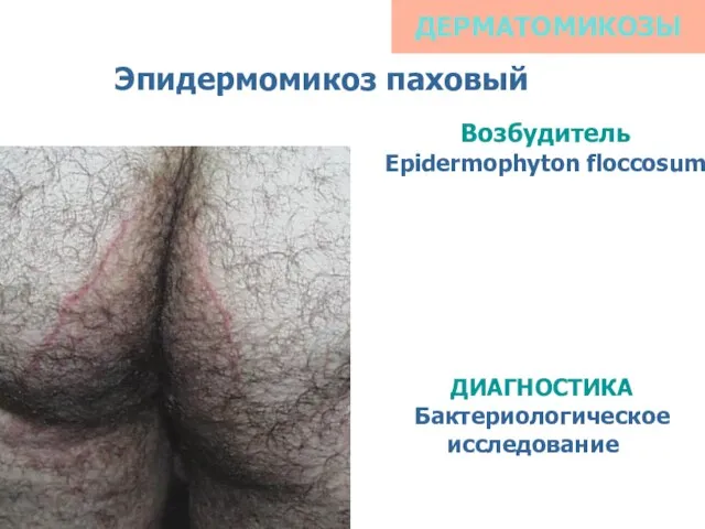 ДЕРМАТОМИКОЗЫ Эпидермомикоз паховый Возбудитель Epidermophyton floccosum ДИАГНОСТИКА Бактериологическое исследование