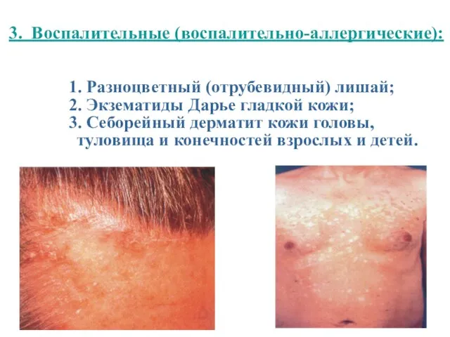 1. Разноцветный (отрубевидный) лишай; 2. Экзематиды Дарье гладкой кожи; 3. Себорейный