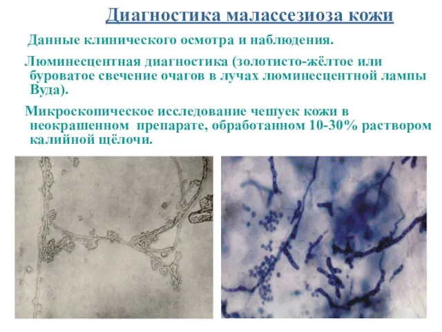 Диагностика малассезиоза кожи Данные клинического осмотра и наблюдения. Люминесцентная диагностика (золотисто-жёлтое