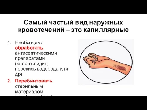 Самый частый вид наружных кровотечений – это капиллярные Необходимо обработать антисептическими