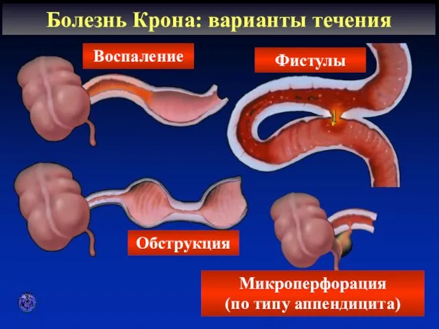 CLINICAL PATTERNS Болезнь Крона: варианты течения Воспаление Фистулы Обструкция Микроперфорация (по типу аппендицита)