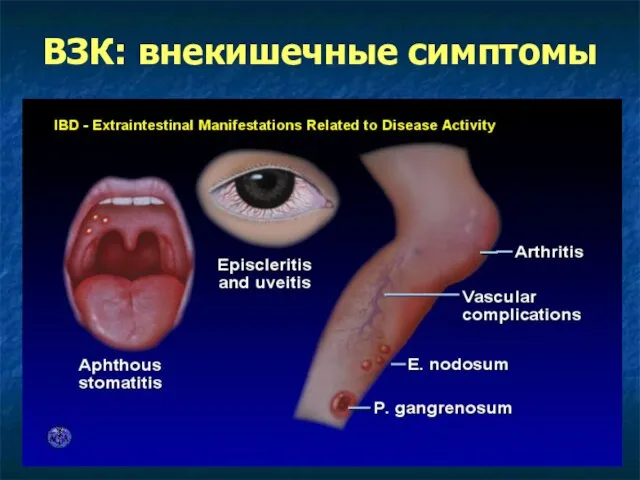 ВЗК: внекишечные симптомы