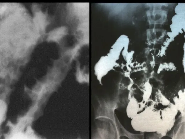 FISTULAE AND SINUS TRACTS