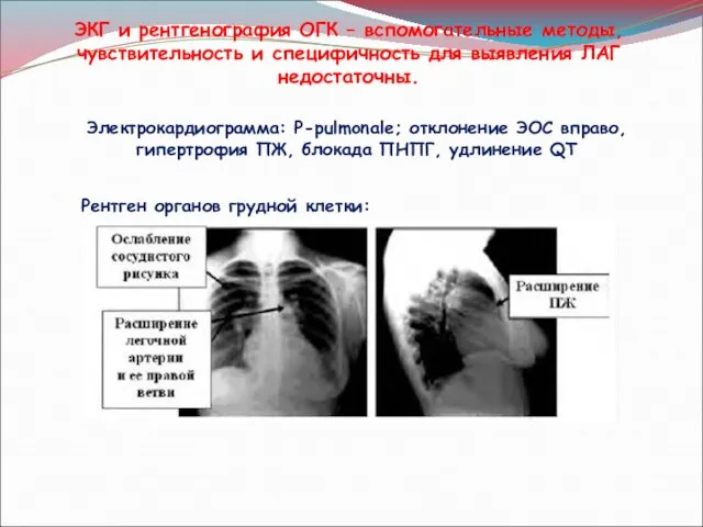 ЭКГ и рентгенография ОГК – вспомогательные методы, чувствительность и специфичность для