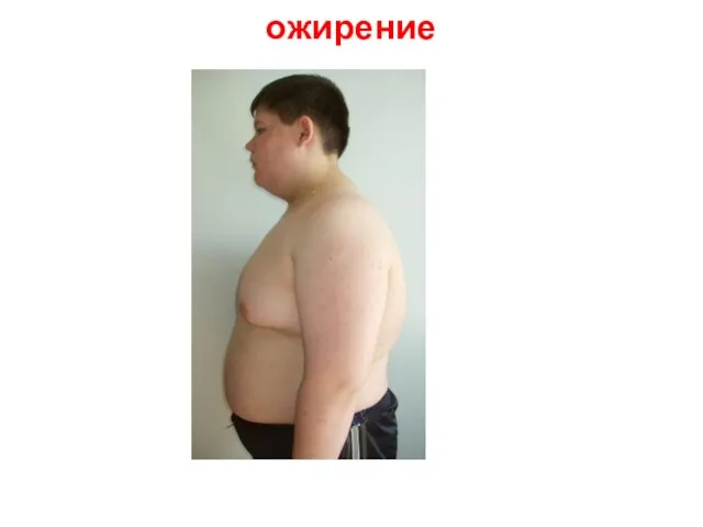 ожирение